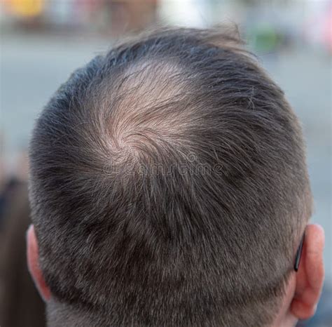 A Bald Spot On A Man`s Head Alopecia Stock Photo Image Of Health