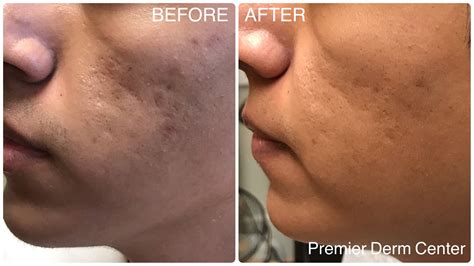 Get Rid Of Acne Scars With Premier Derm Centers Treatment