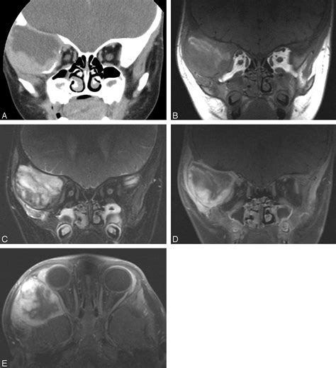 Nodular Fasciitis In The Head And Neck Ct And Mr Imaging Findings