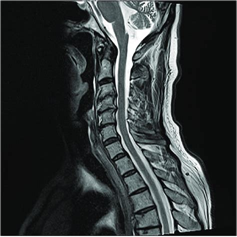 Sagittal Cervical MRI In Weighted T1 Images Showing Signs Of A Dominant