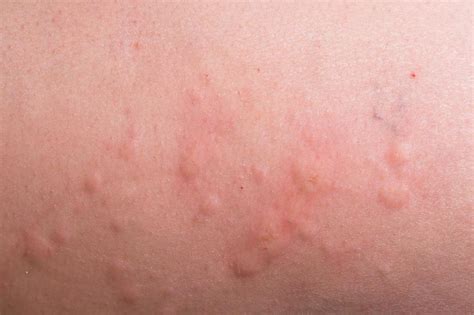 What Is A Chlorine Rash With Pictures