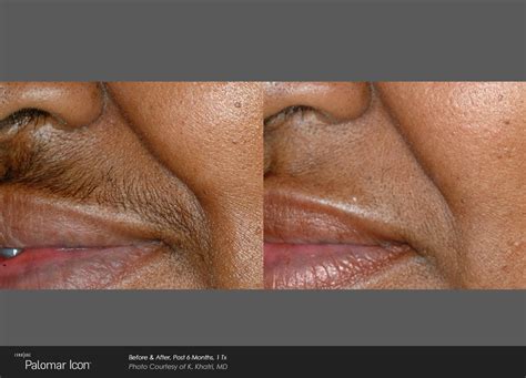 This is because the results with this treatment are long lasting, and even permanent in some cases. Laser Hair Removal | Ocala Plastic Surgery