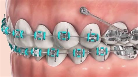 Temporary Anchorage Devices Tad — Tri Valley Orthodontics