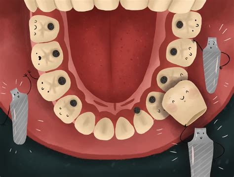 Tanam Gigi Klinik Gigi Kepong
