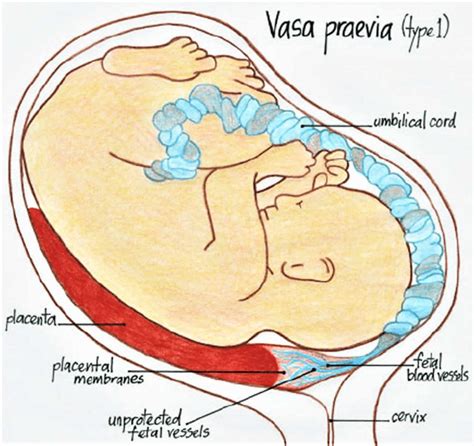 Vasa Previa Definition Causes Symptoms Diagnosis Ultrasound