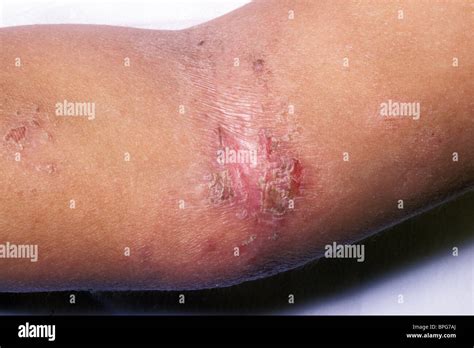 Eczematous Dermatitis Hi Res Stock Photography And Images Alamy