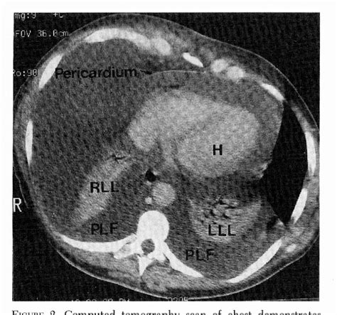 Figure 2 From Cardiac Tamponade Due To Primary Pericardial Lymphoma In
