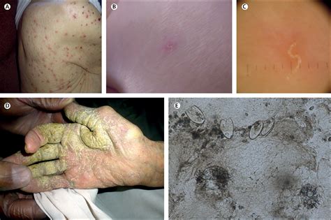 Scabies Outbreaks In Ten Care Homes For Elderly People A Prospective Study Of Clinical Features