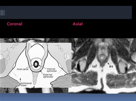 Ppt Mri Imaging Of Perianal Fistula Powerpoint Presentation Free Download Id2986971