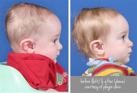 Plagiocephaly The 411