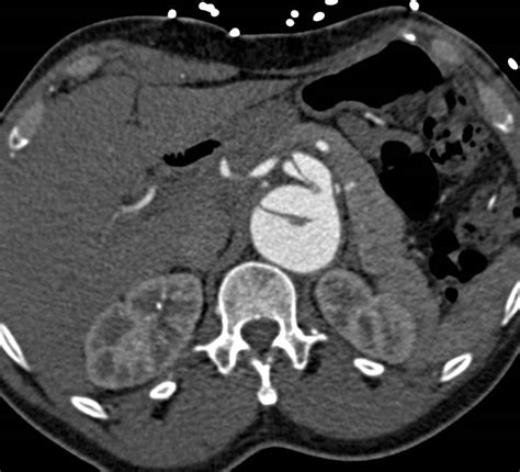 Aortic Dissection Extends Into The Celiac Artery And The Right Renal Artery Vascular Case
