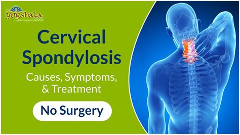 Cervical Spondylosis Causes Symptoms And Treatment Flickr