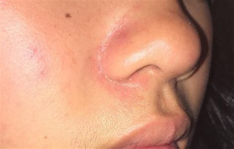 Skin Concern Red And Oily Area Around Nose Yet Flaky And Acne Prone