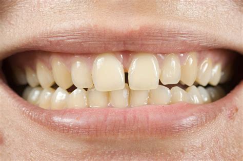 Remedies For Tooth Discoloration Tz Health