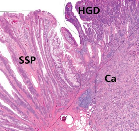 Sessile Serrated Polyps An Important Route To Colorectal Cancer In