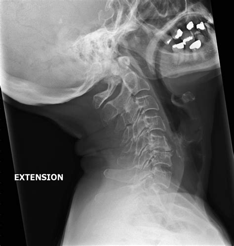 Flexion And Extension Cervical Spine Radiography Wikiradiography