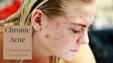 Chronic Acne 5 Foundations To Address Denver Naturopathic Clinic Healing Roots Denver