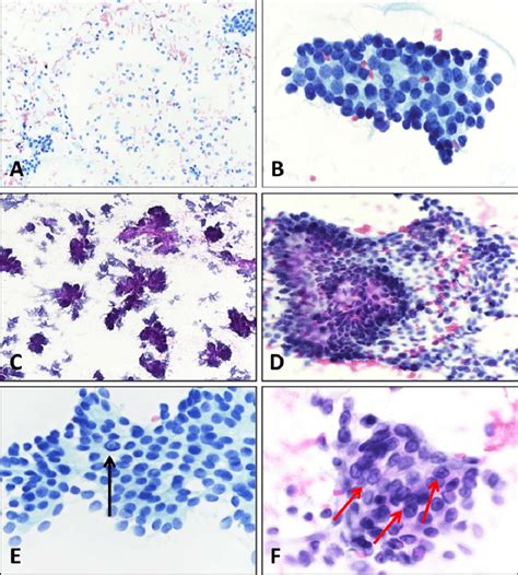 Cytologic Features Of The Columnar Cell Variant Of Papillary Thyroid