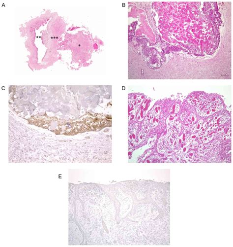 Calcifying Epithelial Odontogenic Tumor Histology