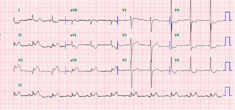 Initial Ekg In Case 1 There Is St Elevation In Lead Ii Iii Avf With