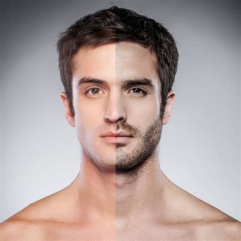 Implante De Barba Antes Y Después Vila Rovira Cirugía Estética Barcelona