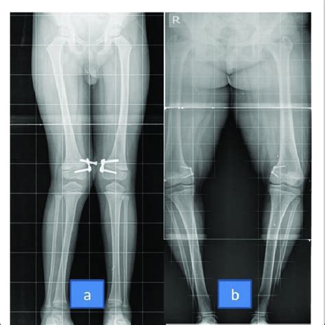 Clinical Photographs Showing Preoperative Genu Valgum Deformity And