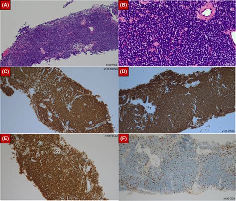 Pulmonary Extra‐nodal Mucosa‐associated Lymphoid Tissue Malt Lymphoma