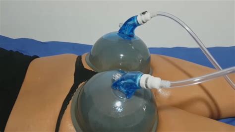 Bsv Buttocks Treatment With Vacuum Therapy Youtube