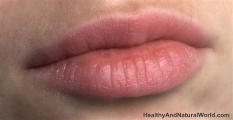 Allergic Bumps On Lips