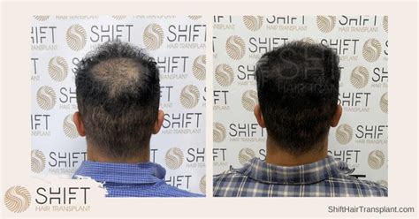 Scalp Micropigmentation In Istanbul Turkey Costs And Results