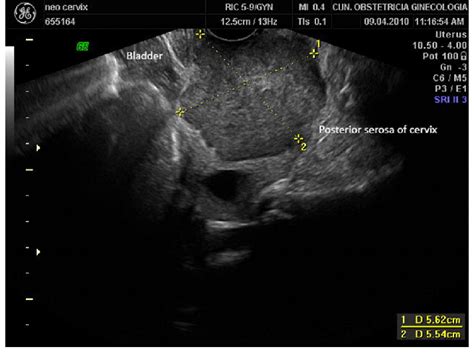 Transvaginal Ultrasound Showing A Large Cervical Cancer In Longitudinal