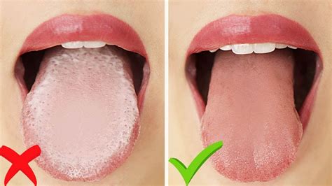 Natural Treatment To Get Rid Of White Tongue Yeyelife