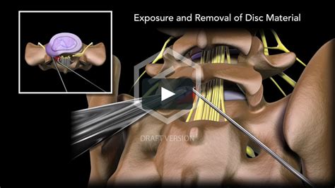 Lumbar Surgery Examples L5s1microdiscectomywm On Vimeo