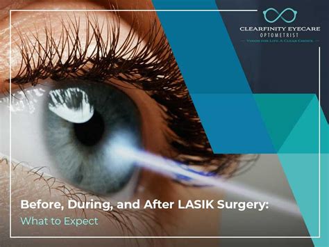 Before During And After LASIK Surgery What To Expect