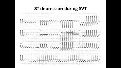 Ecg Course St Depression During Svt Dr Sherif Altoukhy Youtube