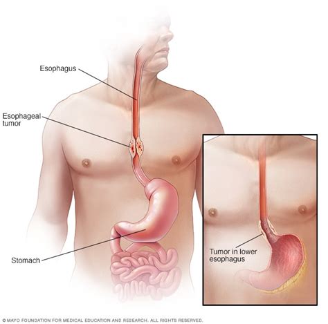 Esophageal Cancer Symptoms And Causes Mayo Clinic