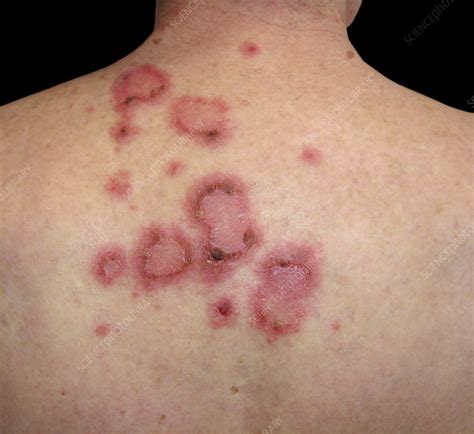 Lupus Erythematosus Stock Image C0548796 Science Photo Library