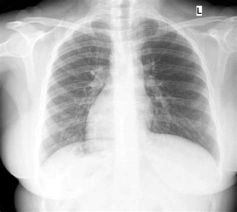 Chest X Ray Showing Dextrocardia And Deformity Of The Right Fourth Rib