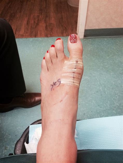 Pin On Bunion Surgeryand Other Factsadvice