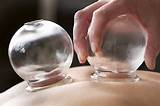 Cupping Glass Therapy Pictures