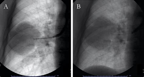 Conventional Fluoroscopy Guided Transbronchial Forceps Biopsy A And