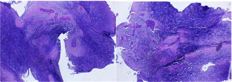 Histopathology Examination Of The Bone Tumor Showing Osteoid Matrix