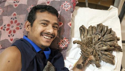 Surgeon Removes Mans Tree Growths Newshub