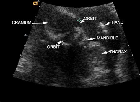 Fetal heart rate patterns are classified. Image Atlas of Normal Pregnancy