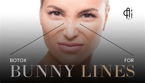 Everything You Need To Know About Botox For Bunny Lines — Art Of Injection