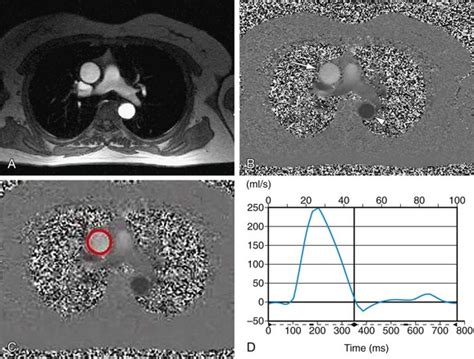 Aortic And Mitral Valvular Disease Radiology Key