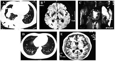 Disseminated Nocardiosis In A Patient With Nephrotic Syndrome Following