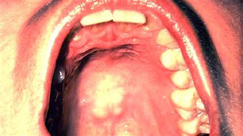 Signs Of Oral Cancer In Cheek Cancerwalls