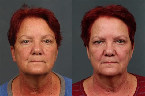 Pico Genesis Laser Treatment Before And After Photos Patient 695