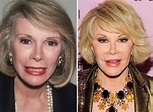 Joan Rivers Facelift Plastic Surgery Before and After | Celebie